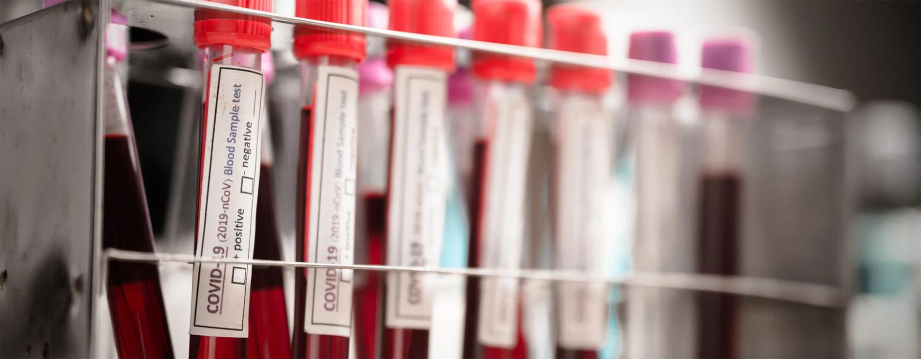 Testiranje na koronavirus